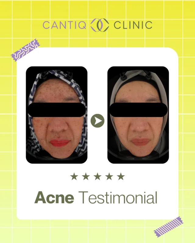 ✨ Real Stories, Real Results ✨
From battling stubborn acne to glowing with confidence 🌸
Our client trusted CANTIQ Clinic with her skin journey — and the transformation speaks for itself!

💛 Clearer skin
💛 Reduced scars
💛 Boosted confidence

At Cantiq, we believe every skin tells a story — and we’re here to make sure yours shines beautifully 🌟

📍 CANTIQ Clinic Klang http://wasap.my/60123099366
📍 CANTIQ Clinic Cheras http://wasap.my/601169411227
📍 CANTIQ Clinic Setapak http://wasap.my/60125689366
📍 CANTIQ Clinic Melaka http://wasap.my/60128619366

#CantiqClinic #AcneTreatment #ClearSkinJourney #CantiqConfession