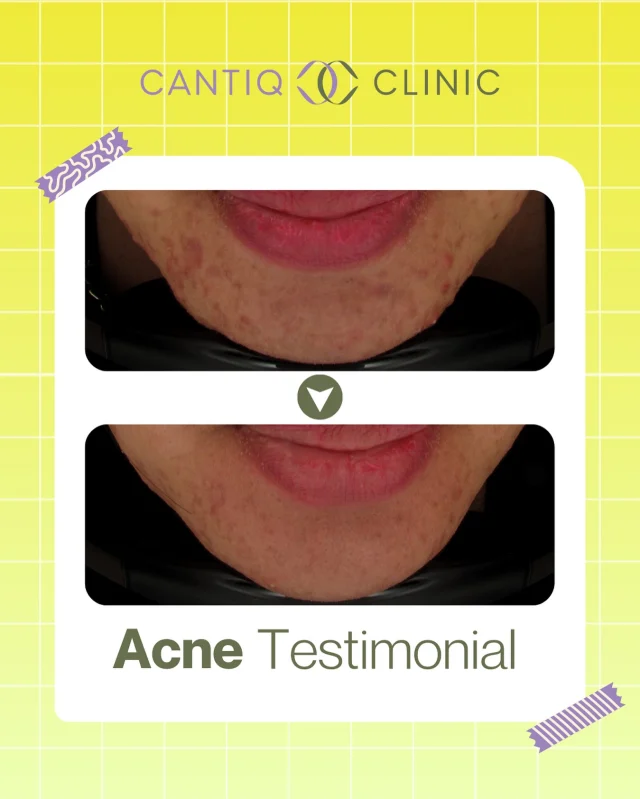 🌟 REAL TESTIMONI CANTIQ CLINIC 🌟
Daripada jerawat & parut yang degil 👉 kepada kulit yang lebih bersih & yakin ✨

Setiap kulit ada ceritanya. Dengan rawatan yang tepat & konsisten, hasilnya memang boleh nampak beza! 💛

Kami gembira dapat jadi sebahagian daripada perjalanan pelanggan kami untuk capai kulit idaman 🫶

📍 CANTIQ Clinic Klang (+6012-3099366)
📍 CANTIQ Clinic Cheras (+6011-69411227)
📍 CANTIQ Clinic Setapak (+6012-5689366)
📍 CANTIQ Clinic Melaka (+6012-8619366)

#CantiqClinic #AcneTreatment #TestimoniCantiq #KulitBersih #RawatanJerawat #CantiqSkin