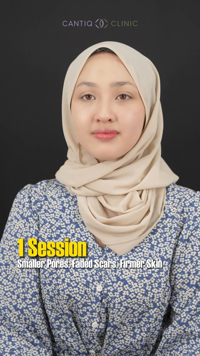 ✨ Struggling with large pores, deep acne scars & uneven skin?
Your skincare products can’t fix collagen loss – but AI SILK WAVE can. 💆‍♀️

🔥 Malaysia’s 1st RF Microneedling + Silkro
✔ Stimulates collagen & repairs skin
✔ Shrinks pores & fades scars
✔ Boosts absorption of your skincare
✔ Short downtime, lasting results

💎 1 session = firmer, smoother, brighter skin
🌟 Limited Slots Available!

📩 PM us now to book before it’s full!

📍 CANTIQ Clinic Klang http://wasap.my/60123099366
📍 CANTIQ Clinic Cheras http://wasap.my/601169411227
📍 CANTIQ Clinic Setapak http://wasap.my/60125689366
📍 CANTIQ Clinic Melaka http://wasap.my/60128619366

📞 WhatsApp us now to book your slot! Limited slots available!

#AISilkWave #CantiqClinic #PoreCare #ScarTreatment #CollagenBoost #GlowingSkinMY #FacialMalaysia #RadiantSkin