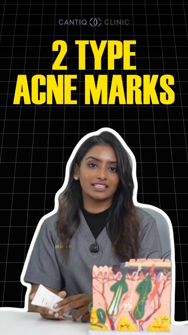😣 Still struggling with acne marks?

There are 2 types:
✔ Dark spots (PIH) – these can fade with sunscreen + brightening care
❌ Pitted scars – creams alone can’t rebuild lost collagen, that’s why they stay

But don’t give up ✨ Scars can be improved with the right treatment guided by a doctor.

We treat this every single day – and we can help you too. 💆‍♀️
📩 DM us now to start your scar recovery journey.

📍 CANTIQ Clinic Klang http://wasap.my/60123099366
📍 CANTIQ Clinic Cheras http://wasap.my/601169411227
📍 CANTIQ Clinic Setapak http://wasap.my/60125689366
📍 CANTIQ Clinic Melaka http://wasap.my/60128619366

📞 WhatsApp us now to book your slot! Limited slots available!

#AcneScarTreatment #CantiqClinic #ClearSkinJourney #SkinHealing #ScarCare