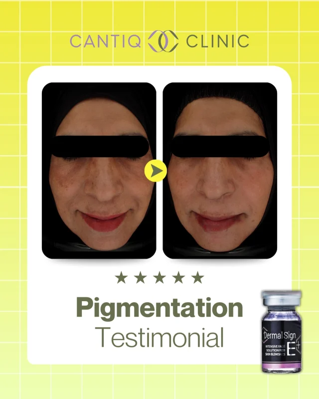 🌟 REAL TESTIMONI CANTIQ CLINIC 🌟
Daripada kulit kusam & tompok jeragat 👉 kepada wajah yang lebih cerah, sekata & berseri ✨

Setiap kulit ada cabarannya. Dengan rawatan yang sesuai & konsisten, masalah PIE, PIH atau pigmentasi boleh dirawat dengan lebih berkesan 💛

Kami bangga jadi sebahagian daripada perjalanan pelanggan kami untuk capai kulit sihat & yakin semula 🫶

📍 CANTIQ Clinic Klang (+6012-3099366)
📍 CANTIQ Clinic Cheras (+6011-69411227)
📍 CANTIQ Clinic Setapak (+6012-5689366)
📍 CANTIQ Clinic Melaka (+6012-8619366)

#CantiqClinic #PigmentationTreatment #TestimoniCantiq #KulitSekata #RawatanPigmentasi #CantiqSkin