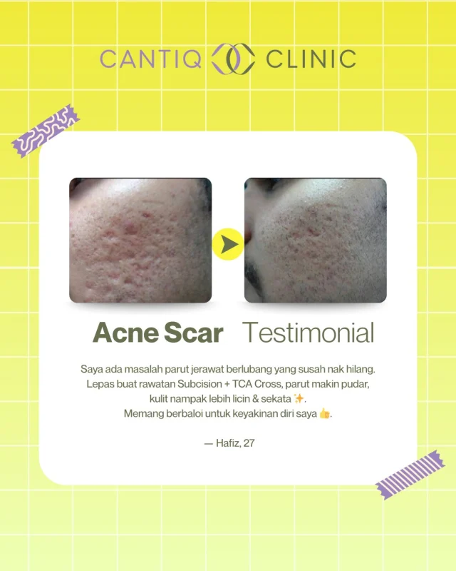 ✨ REAL TESTIMONI CANTIQ CLINIC ✨
Parut jerawat berlubang memang buat ramai hilang keyakinan 😔… tapi jangan risau, ada jalan penyelesaiannya!

Rawatan Subcision + TCA Cross di Cantiq Clinic membantu:
✔ Memudarkan parut jerawat degil
✔ Kulit lebih licin & sekata
✔ Keyakinan diri kembali bersinar ✨

Macam kisah Hafiz — dari kulit penuh parut 👉 kini lebih smooth & bersih! 💛

📍 CANTIQ Clinic Klang http://wasap.my/60123099366
📍 CANTIQ Clinic Cheras http://wasap.my/601169411227
📍 CANTIQ Clinic Setapak http://wasap.my/60125689366
📍 CANTIQ Clinic Melaka http://wasap.my/60128619366

#CantiqClinic #AcneScarTreatment #Subcision #TCACross #TestimoniCantiq #KulitLicin
