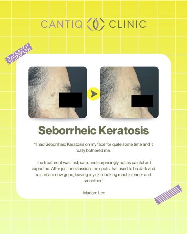 Seborrheic Keratosis ialah ketumbuhan kulit tidak berbahaya yang biasa berlaku bila usia meningkat.
Ia kelihatan seperti bintik gelap, kasar atau tebal di kulit.
Ramai memilih rawatan atas faktor penampilan & keselesaan ✨

📍 CANTIQ Clinic Klang (+6012-3099366)
📍 CANTIQ Clinic Cheras (+6011-69411227)
📍 CANTIQ Clinic Setapak (+6012-5689366)
📍 CANTIQ Clinic Melaka (+6012-8619366)
📍 CANTIQ Signature (KL) (+60122039366)